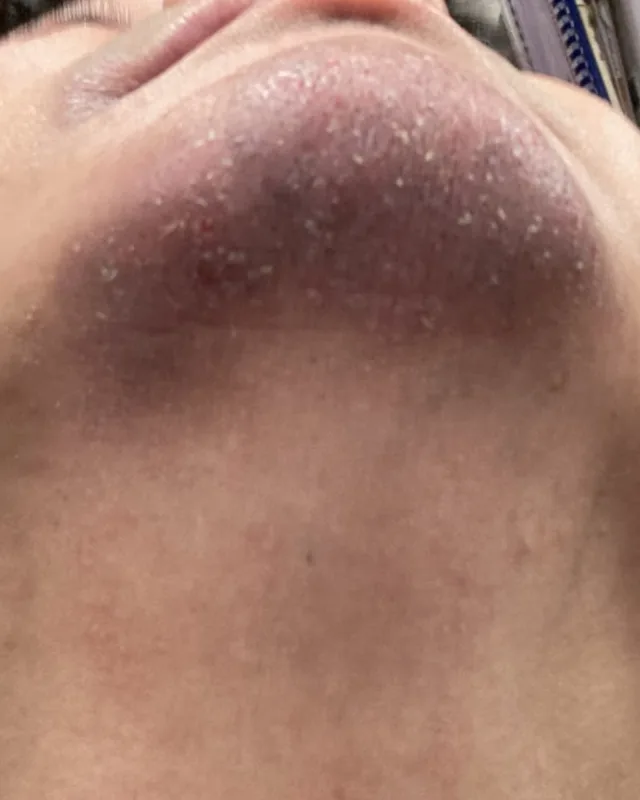 Close crop of chin skin and the mouth edge in the photograph labelled 24 August
