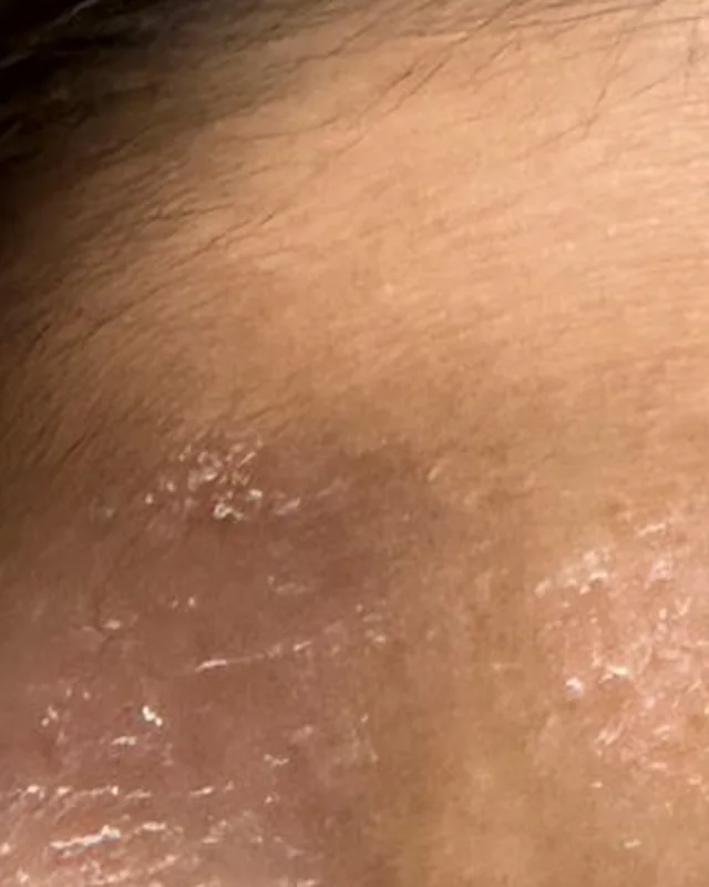 Close crop of forehead skin in the Day 0 photograph