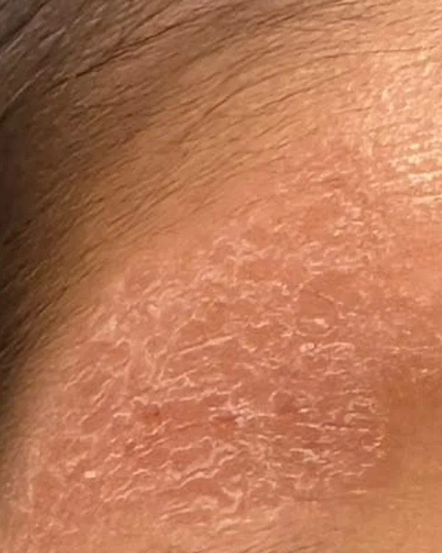 Close crop of forehead skin in the Day 10 photograph