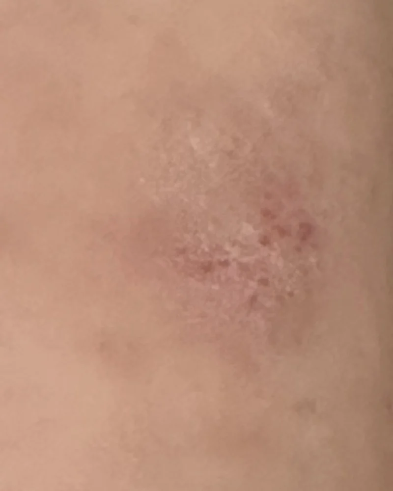 Close crop of the left inner elbow on 11 July, with a small rough-looking patch