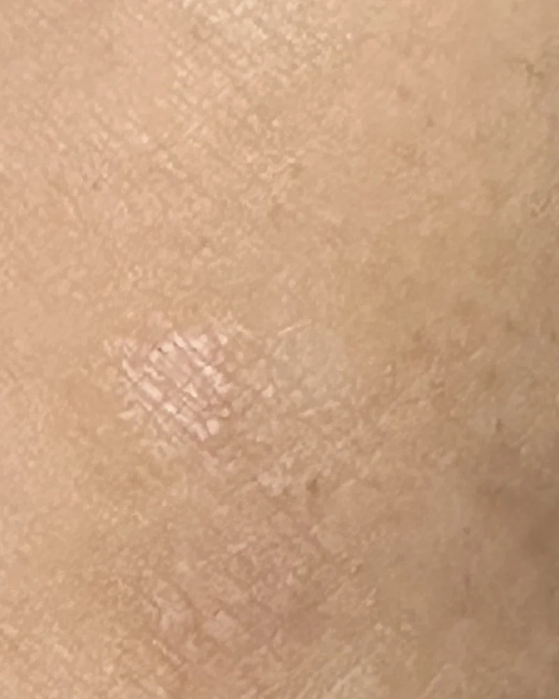 Close crop of the same inner elbow on 29 August, photographed under different lighting