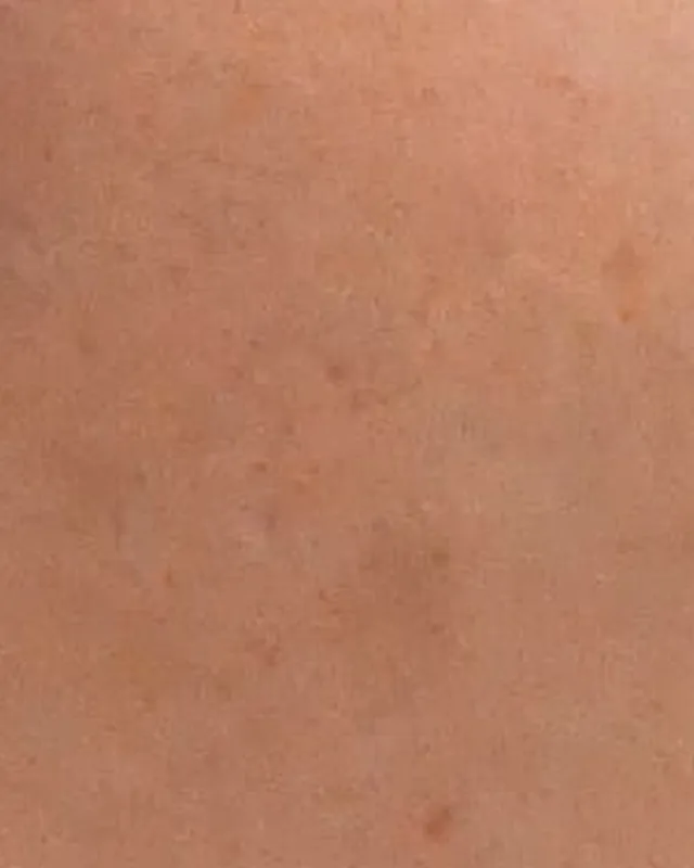 Close crop of right cheek skin in a later photograph
